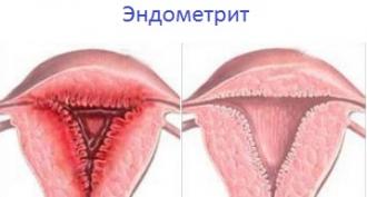 Эндометрит: признаки и лечение воспаления слизистой матки